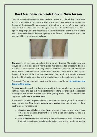 Best Varicose vein solution in New Jersey - slide 1