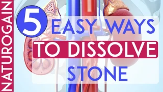 5 Easy Ways to Dissolve Kidney Stone, Improve Kidney Health