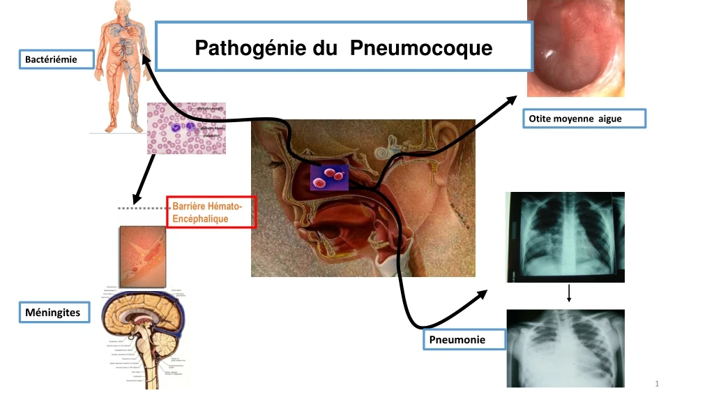 pathog nie du pneumocoque