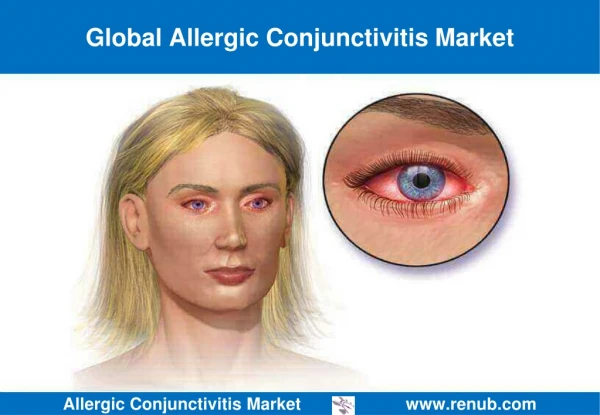 Allergic Conjunctivitis Market Outlook
