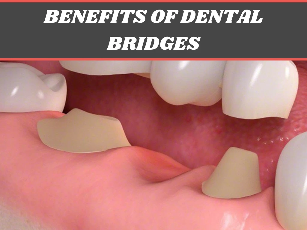 benefits of dental bridges