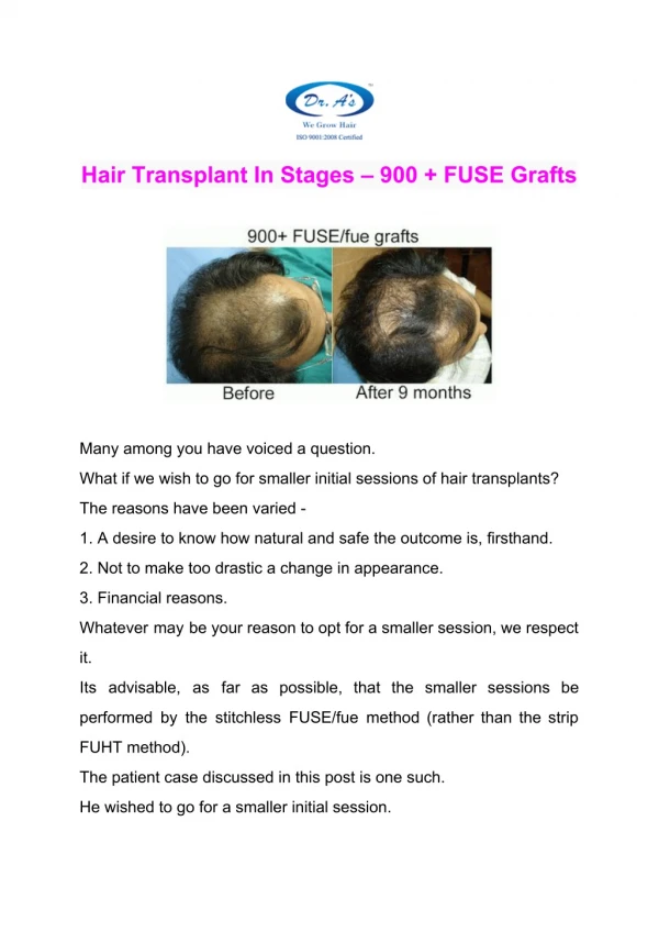 Hair Transplant In Stages – 900 FUSE Grafts