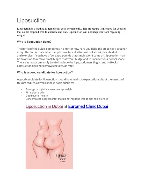 Liposuction (Full Guide)
