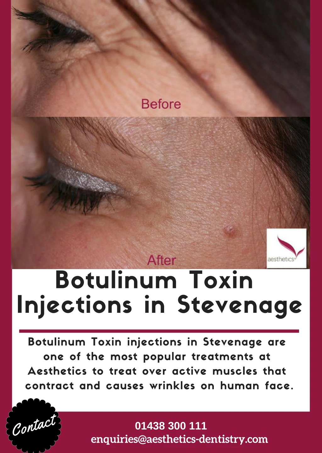 botulinum toxin injections in stevenage