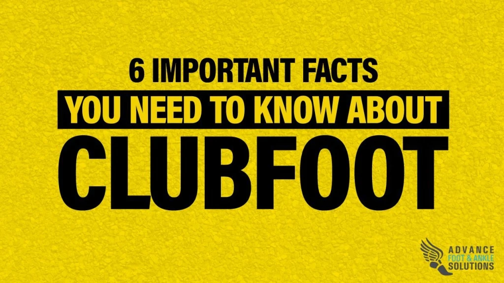 6 important facts you need to know about clubfoot