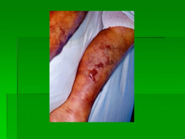 Calciphylaxis AM report Lisa Rose-Jones, MD May 2, 2009