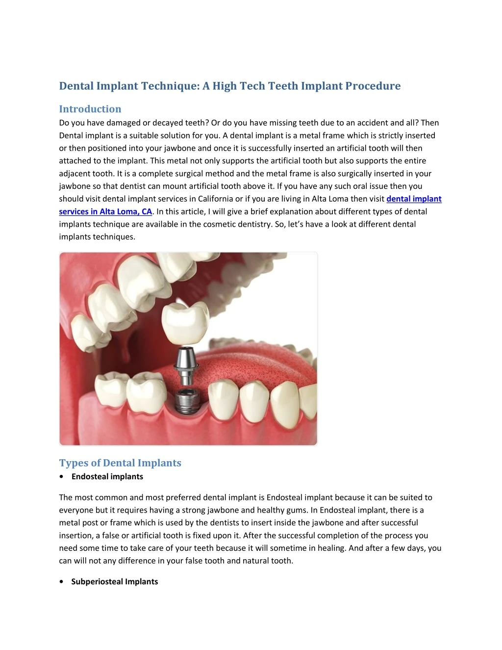 dental implant technique a high tech teeth