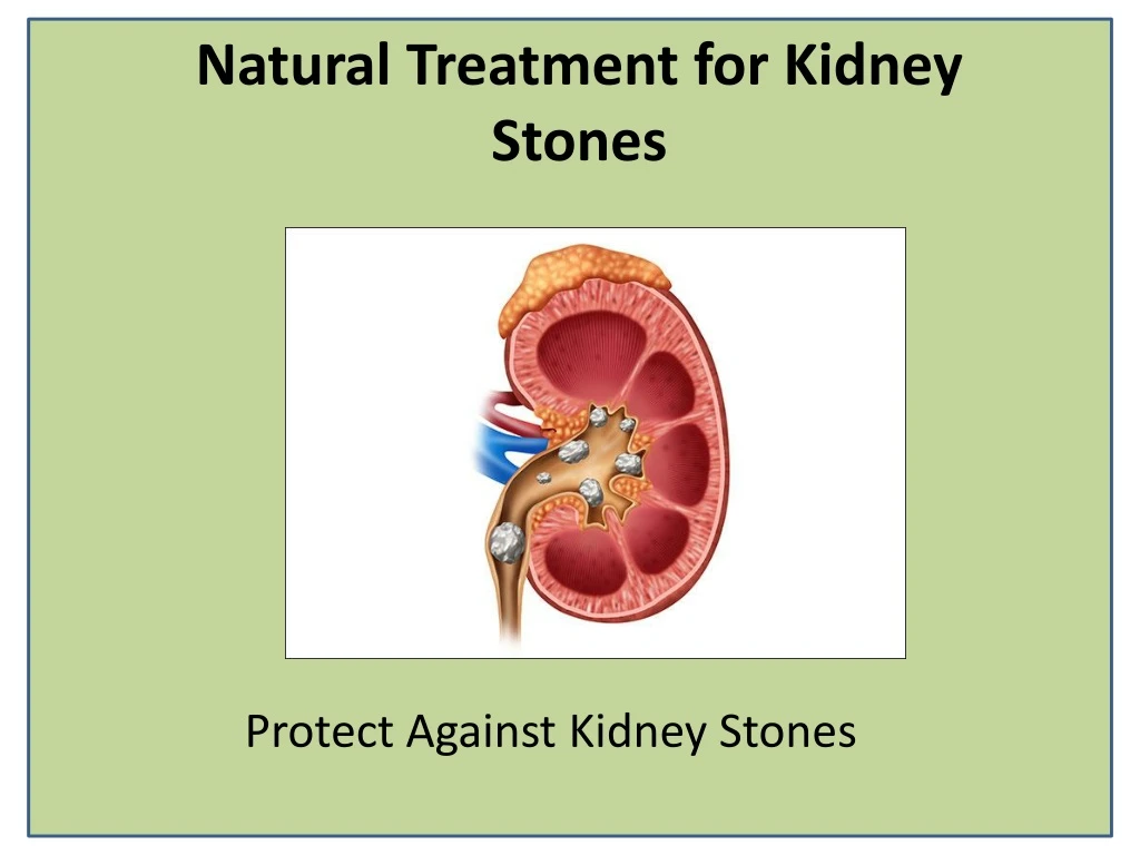 natural treatment for kidney stones