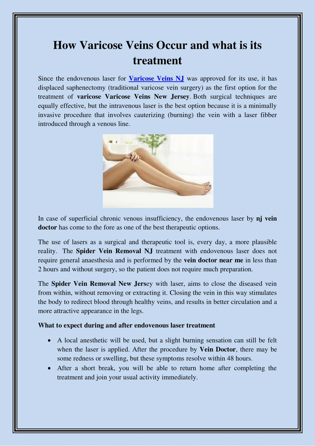 how varicose veins occur and what is its treatment