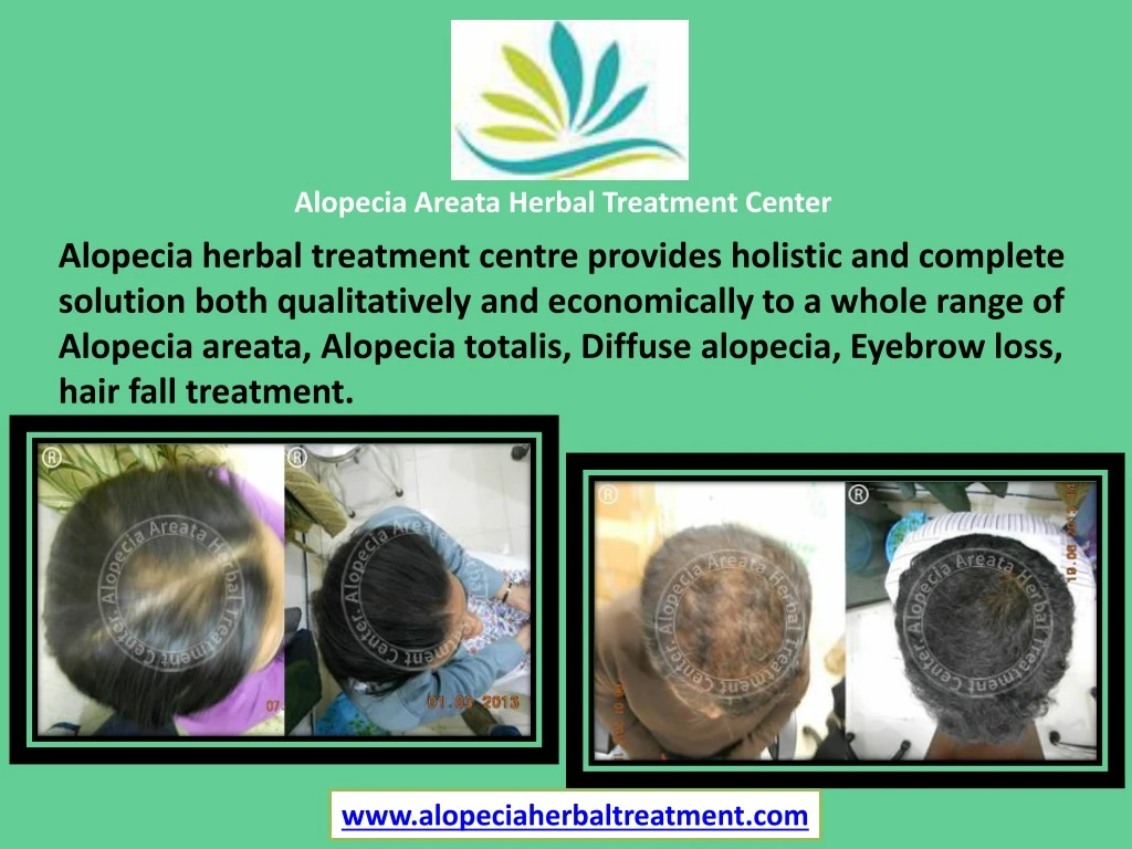 alopecia areata herbal treatment center