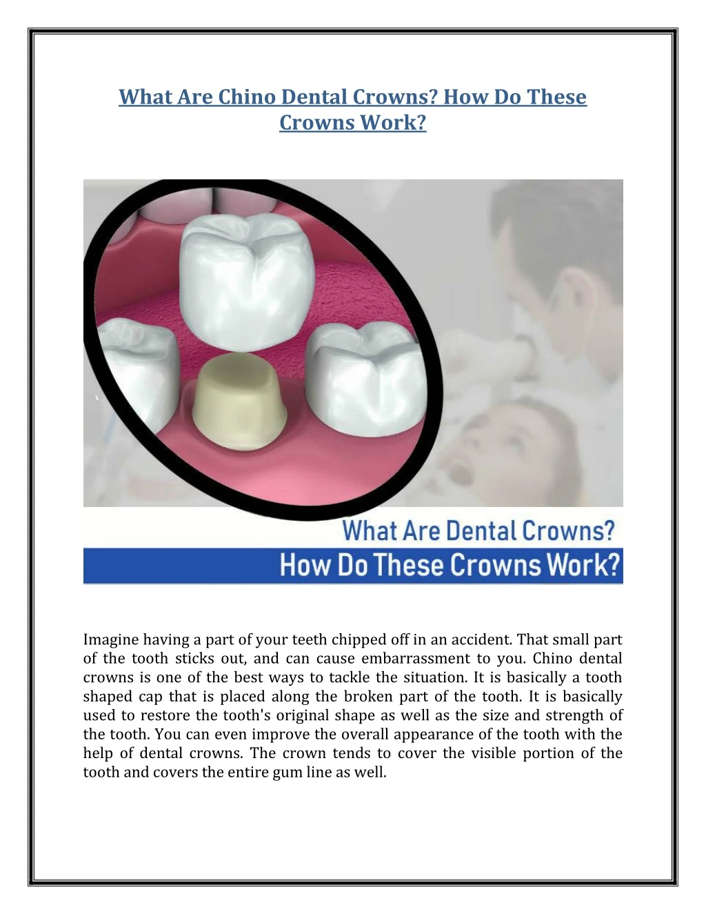 what are chino dental crowns how do these crowns
