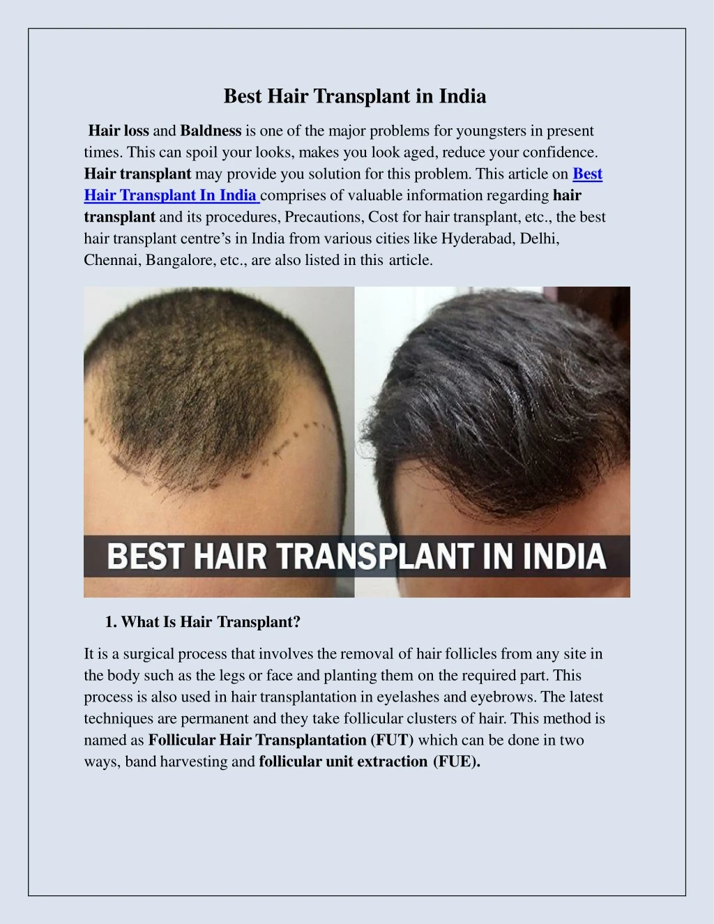 best hair transplant in india hair loss