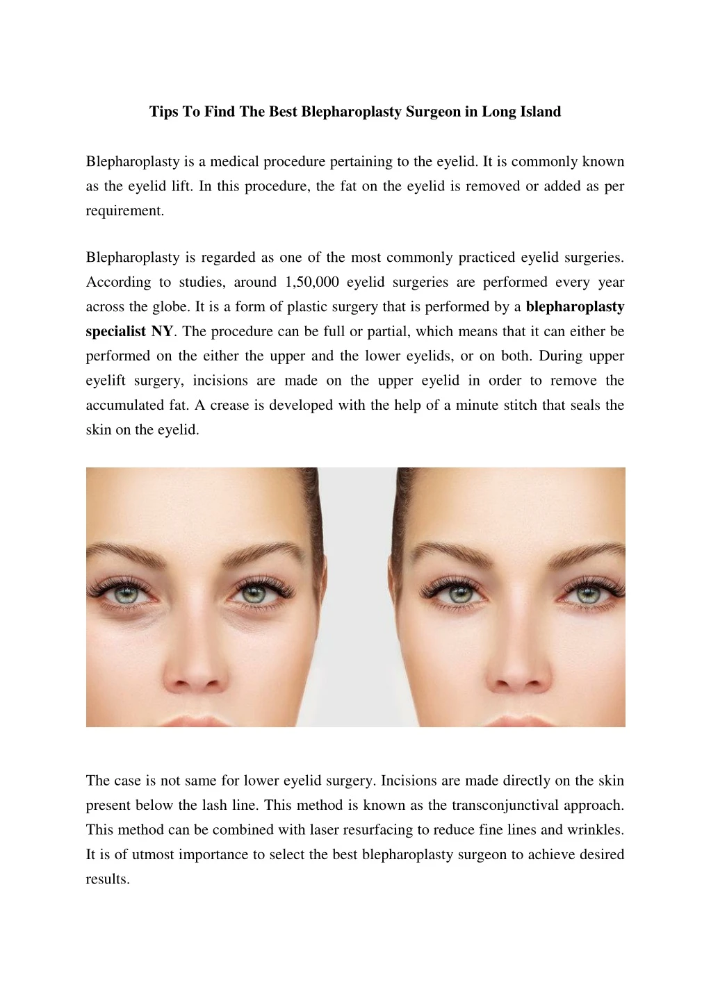 tips to find the best blepharoplasty surgeon