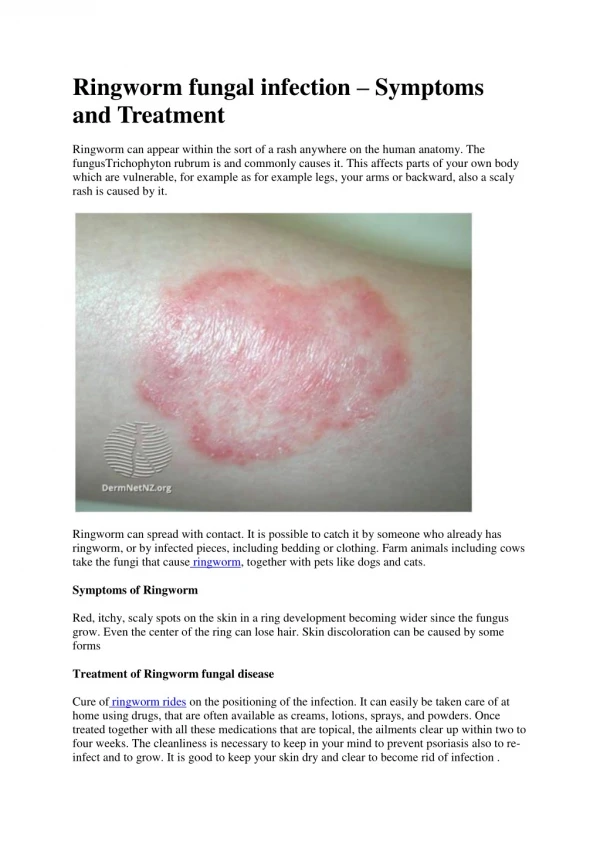 Ringworm fungal infection – Symptoms and Treatment