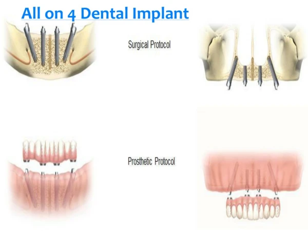 Is All-on-4 Dental Implant best for your teeth and your money as well