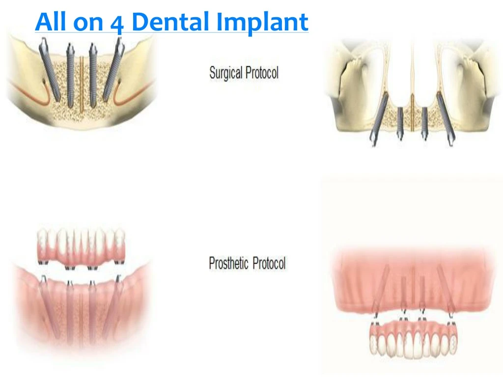 all on 4 dental implant