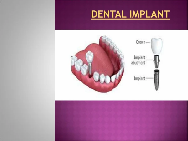 Is Dental Implant in Abroad (Budapest) A Miracle