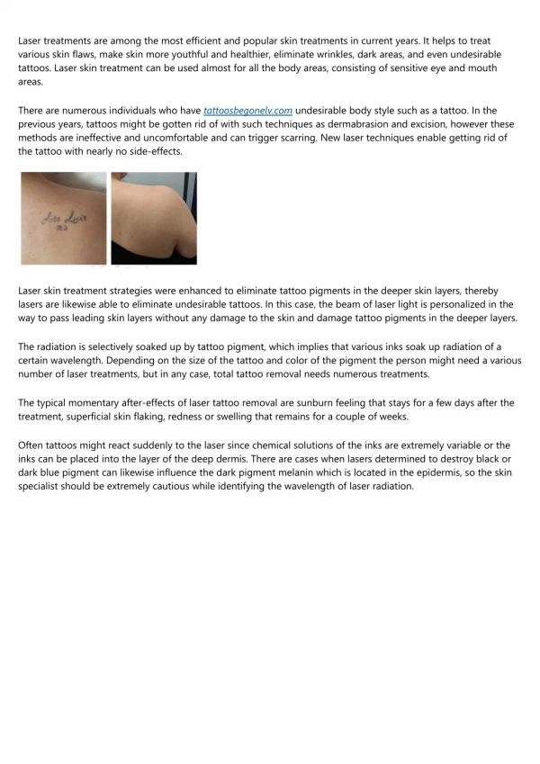 Laser Tattoo Removal - Method, Benefits, And Unwanted Impacts