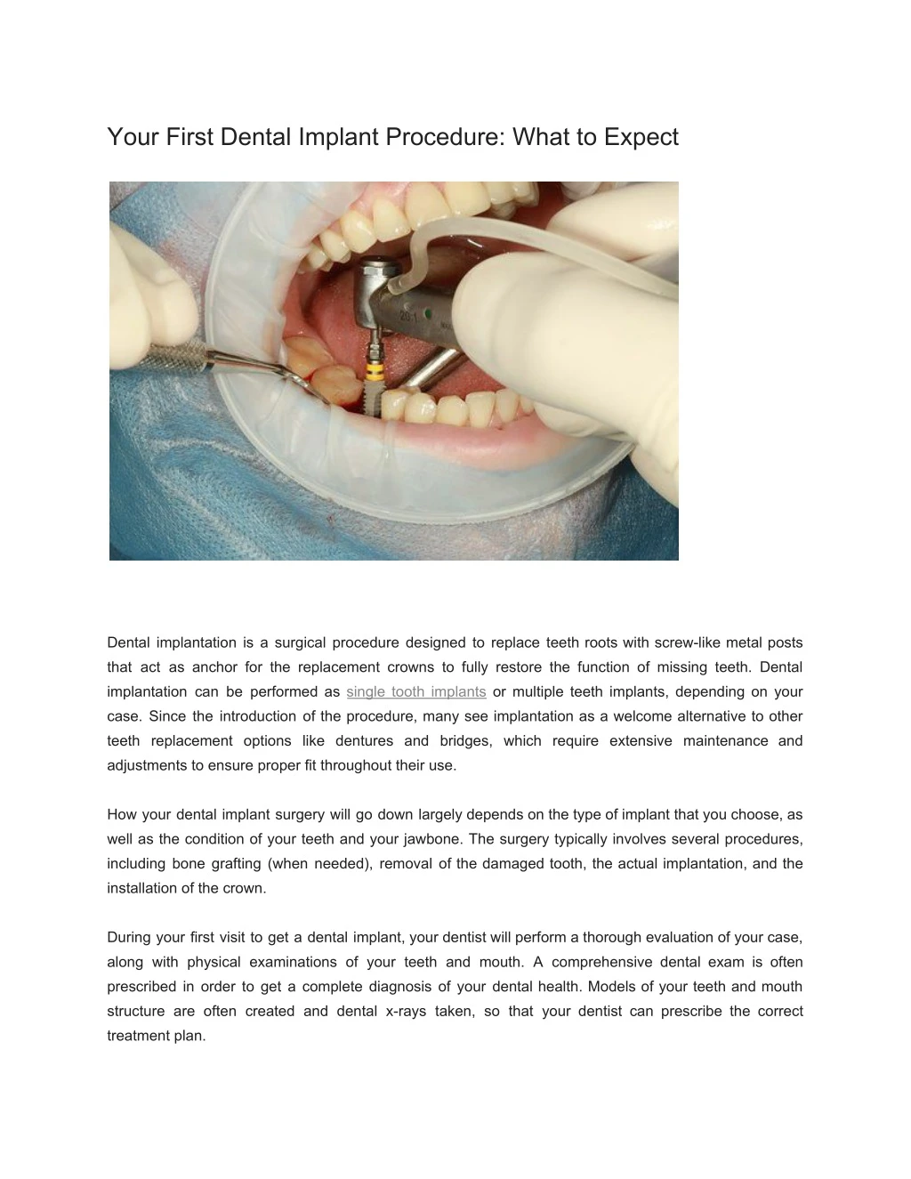 your first dental implant procedure what to expect