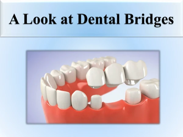 A Look at Dental Bridges