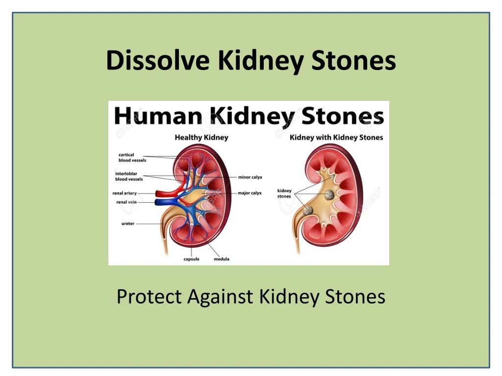 dissolve kidney stones