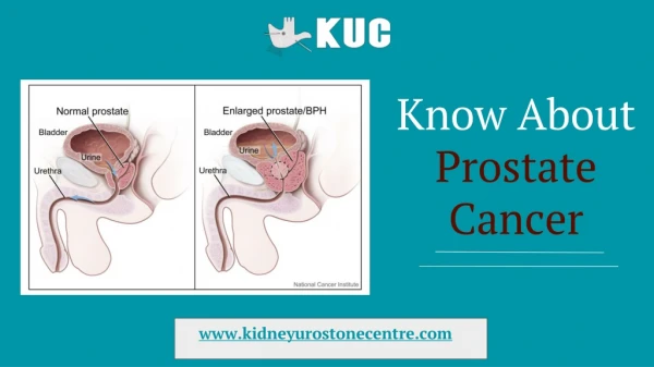 Know About Prostate Cancer