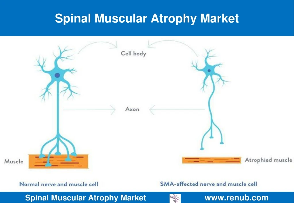 spinal muscular atrophy market