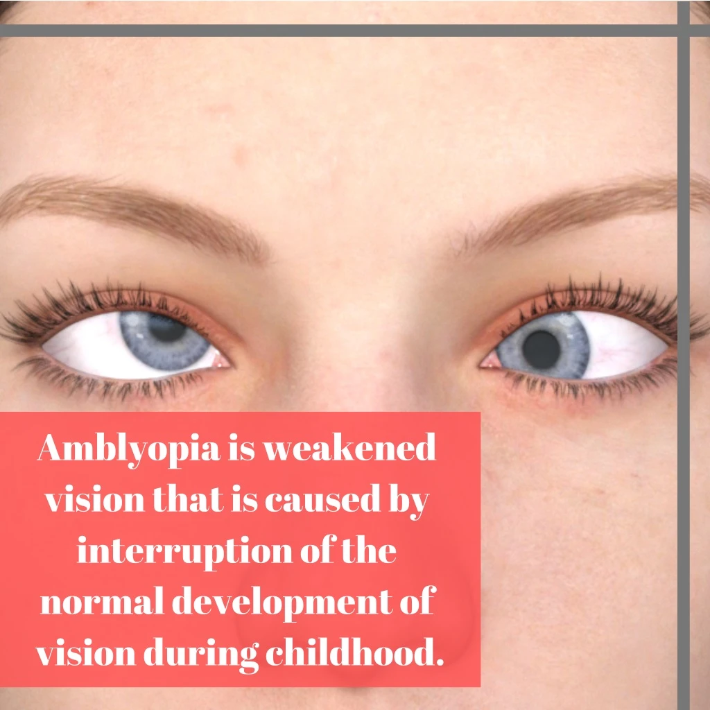 amblyopia is weakened vision that is caused