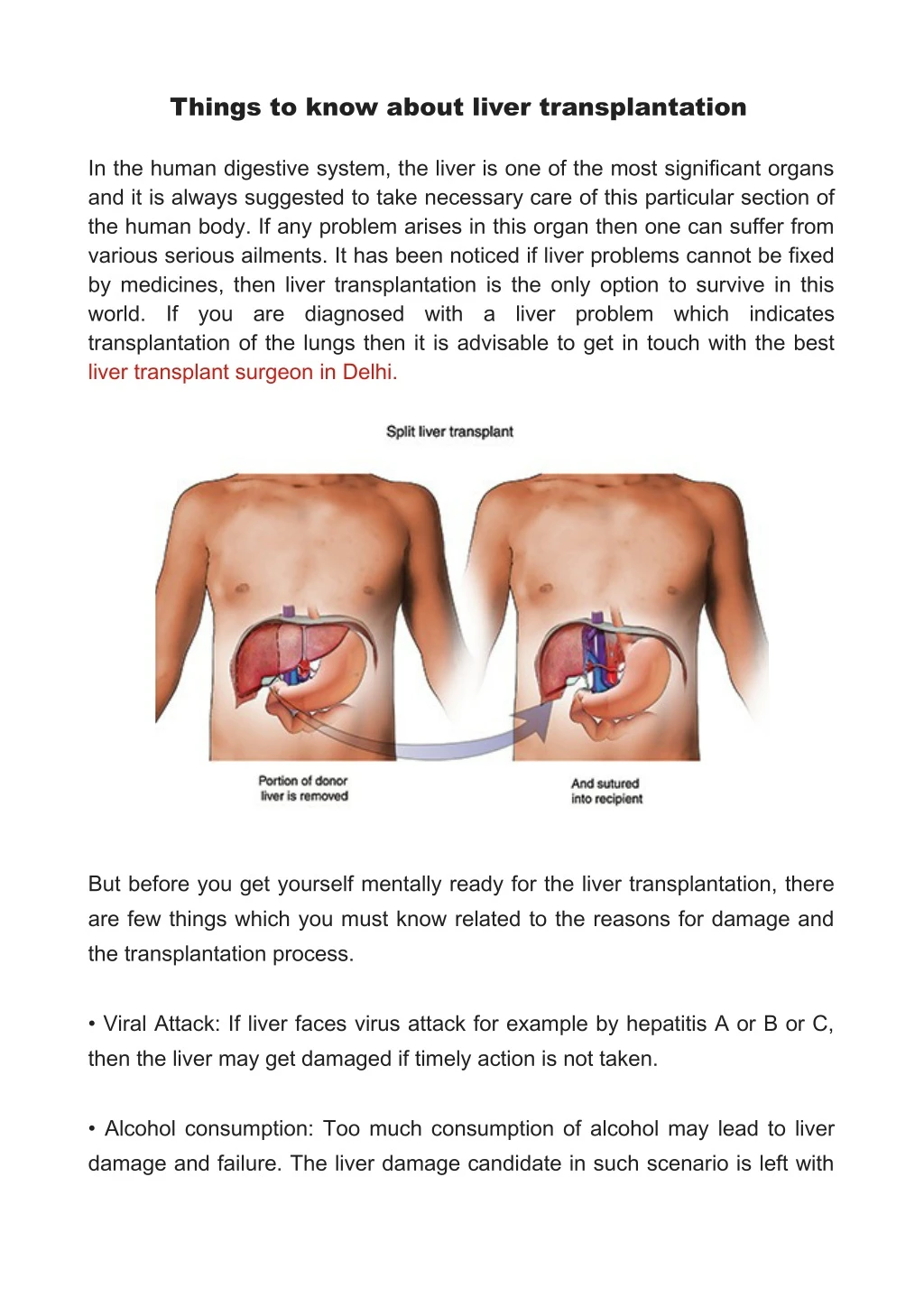 things to know about liver transplantation