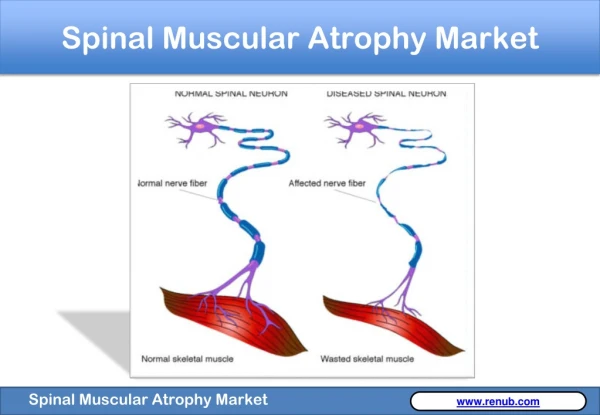 Spinal muscular atrophy (SMA) is one of the most common genomic disorders which are caused due to the loss of specialize