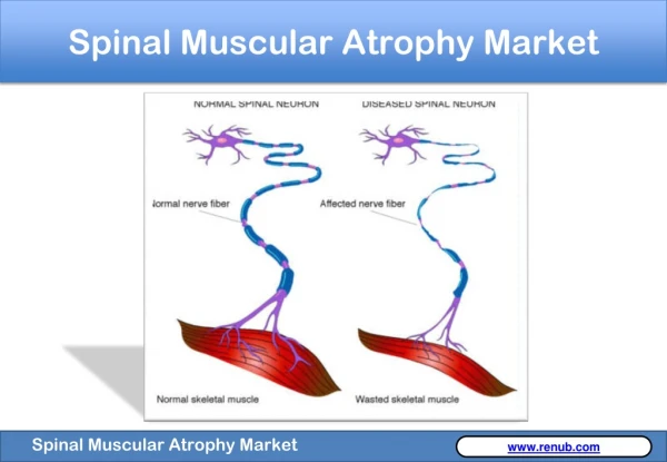 Spinal Muscular Atrophy Market to grow at a CAGR of 14%