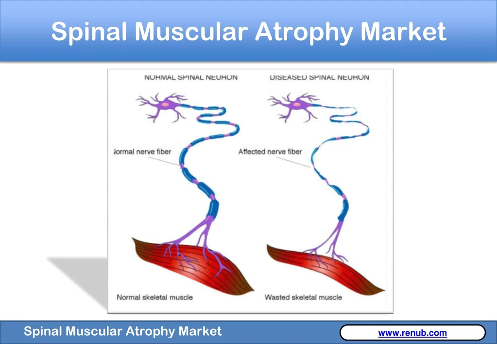 spinal muscular atrophy market