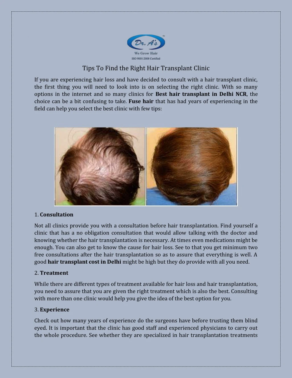 tips to find the right hair transplant clinic