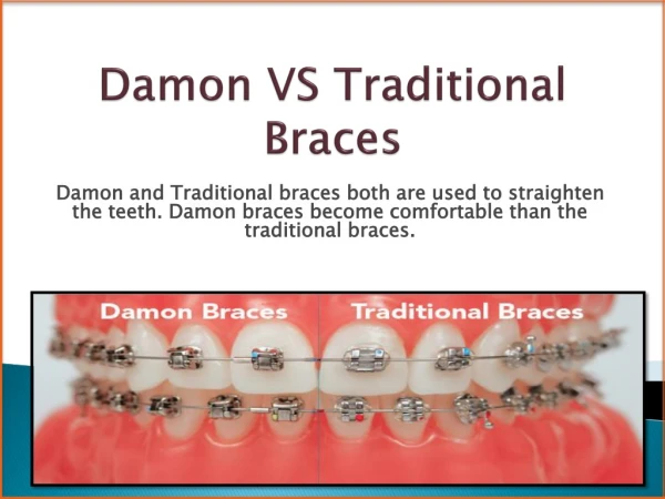Reasons Why Damon Braces are Differing to The Traditional Braces