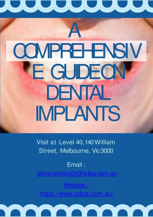A Comprehensive Guide On Dental Implants