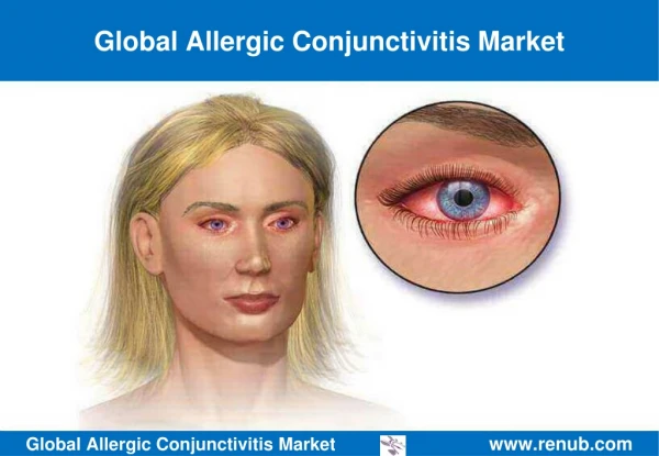 Global Allergic Conjunctivitis Market Growth