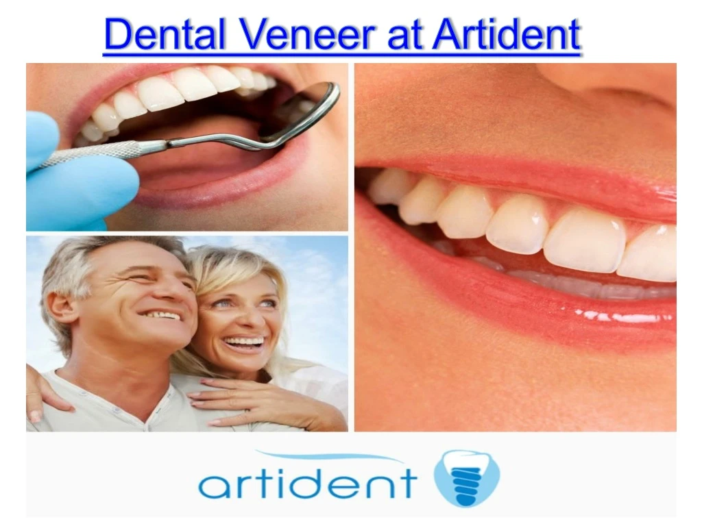 dental veneer at artident