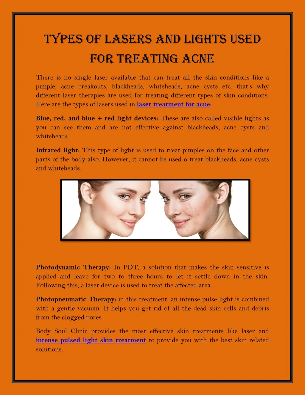 types of lasers and lights used for treating acne