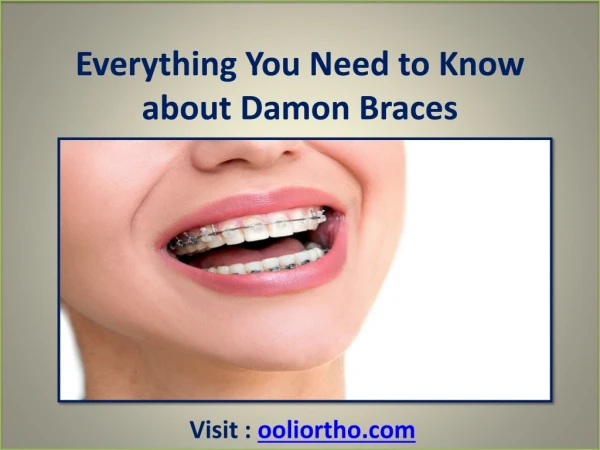 Everything You Need to Know about Damon Braces