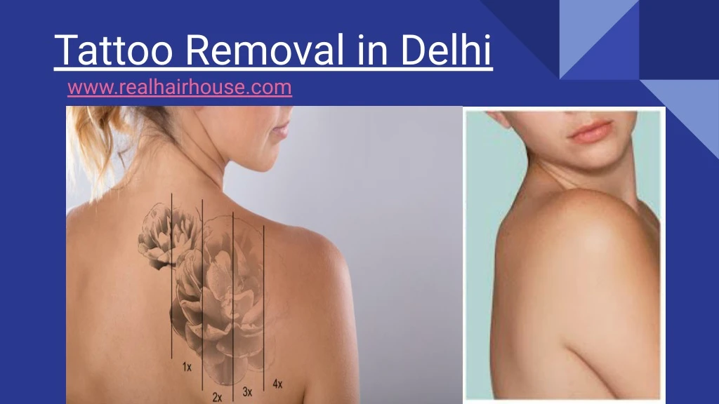 tattoo removal in delhi www realhairhouse com