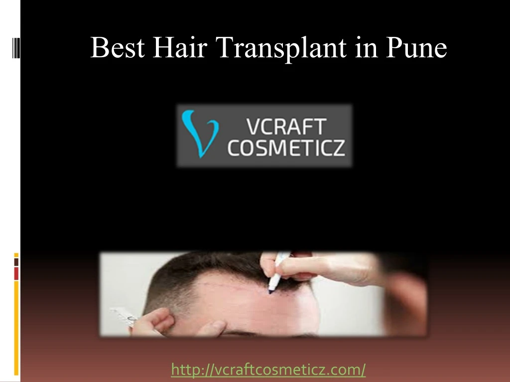 best hair transplant in pune