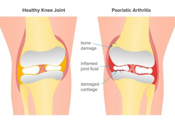Psoriatic Arthritis in Victoria