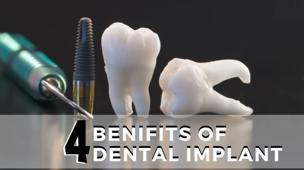 Ppt Benefits Of Dental Implants Powerpoint Presentation Free Download Id