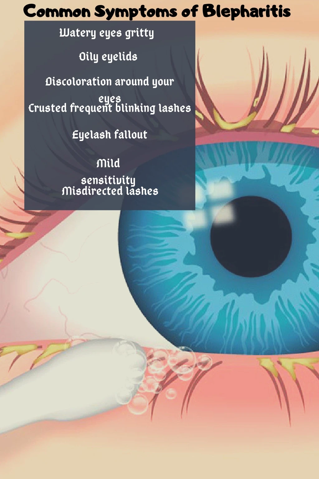 common symptoms of blepharitis watery eyes gritty