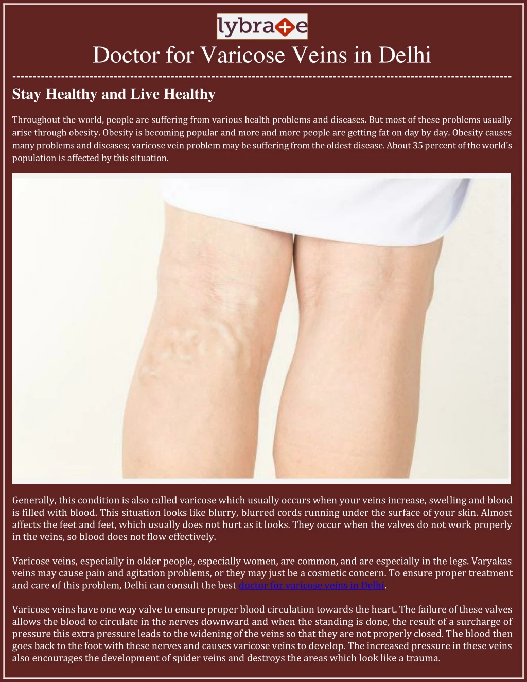 doctor for varicose veins in delhi stay healthy