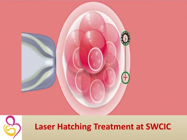 Laser Hatching Technique