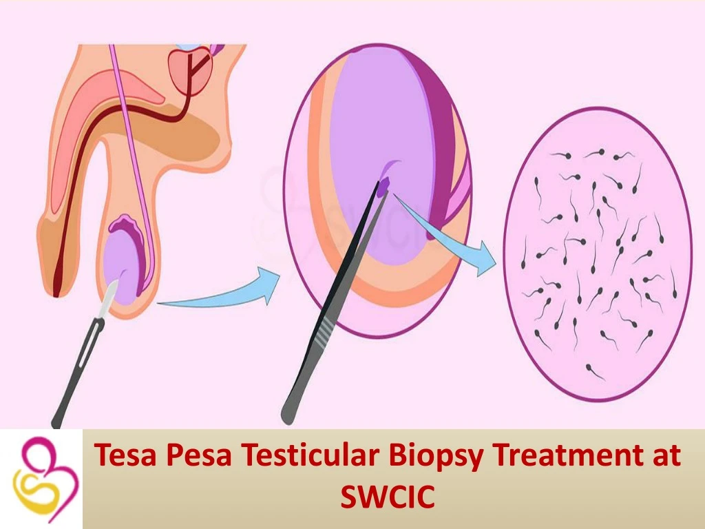 tesa pesa testicular biopsy treatment at swcic