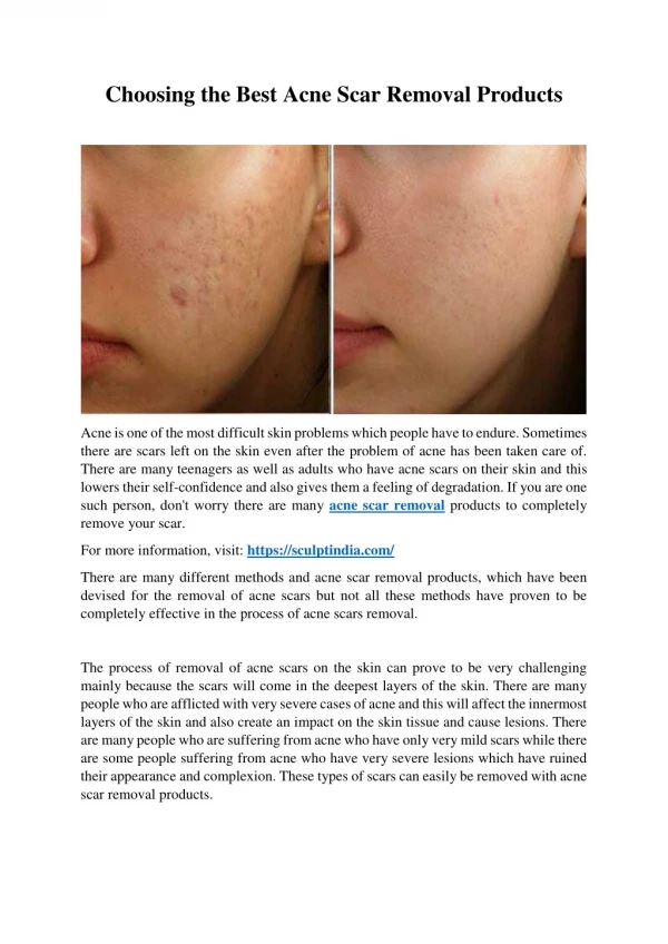 Choosing the Best Acne Scar Removal Products