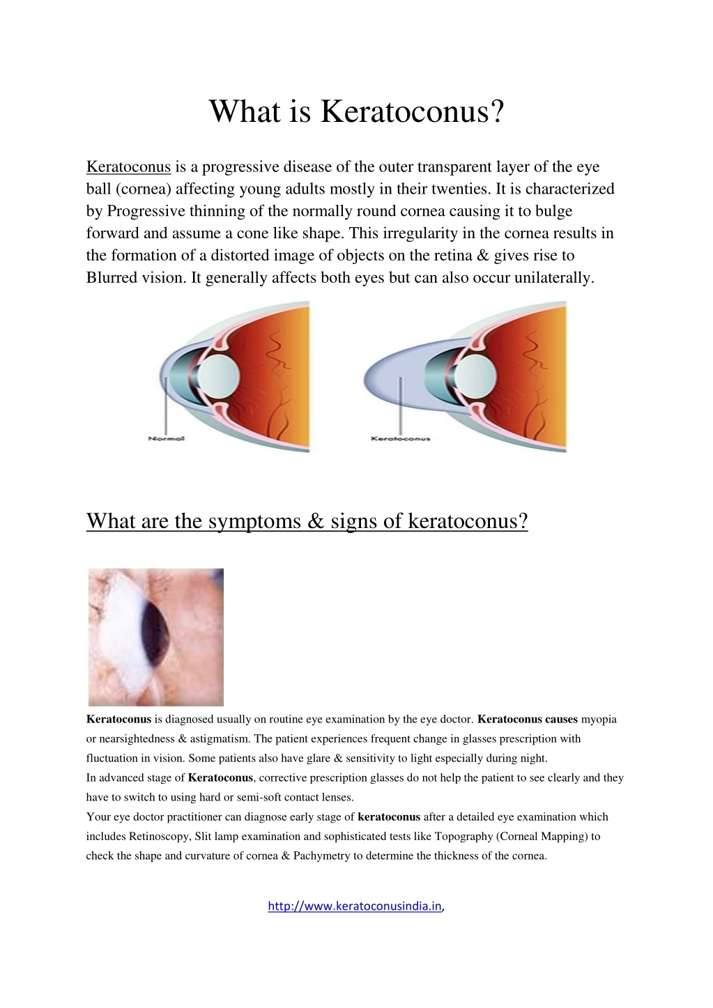 what is keratoconus