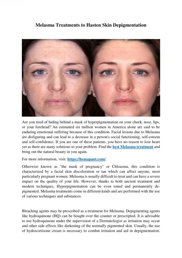 Melasma Treatments to Hasten Skin Depigmentation
